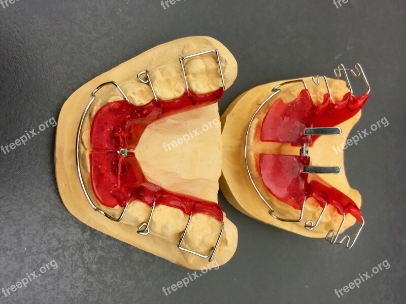 Orthodontics Dental Braces Plaster Model Dentistry Tooth