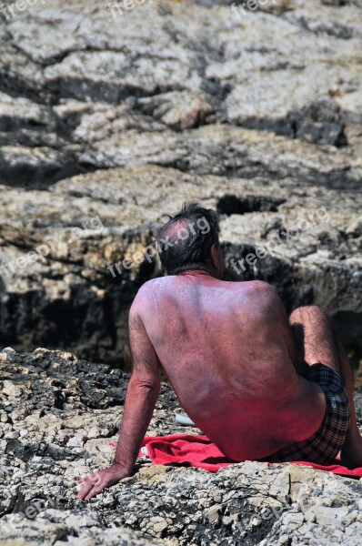 Beach Sunburn Concerns Summer Sun