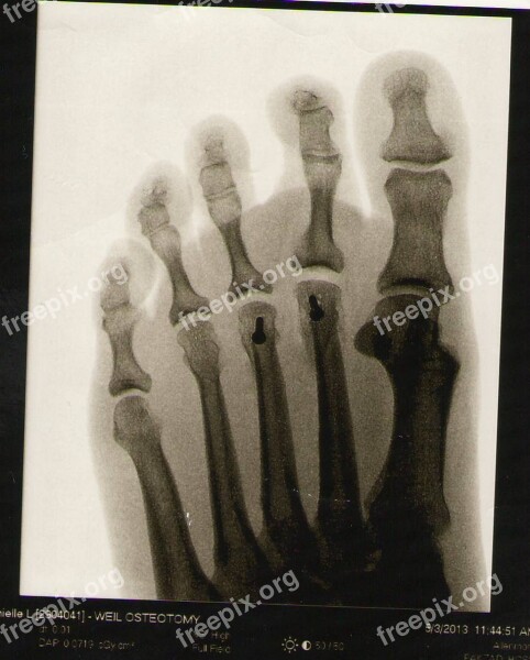 Foot Xray Skeleton Anatomy Bone