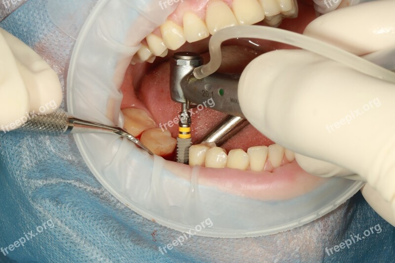 Dental Implant Surgery Free Photos