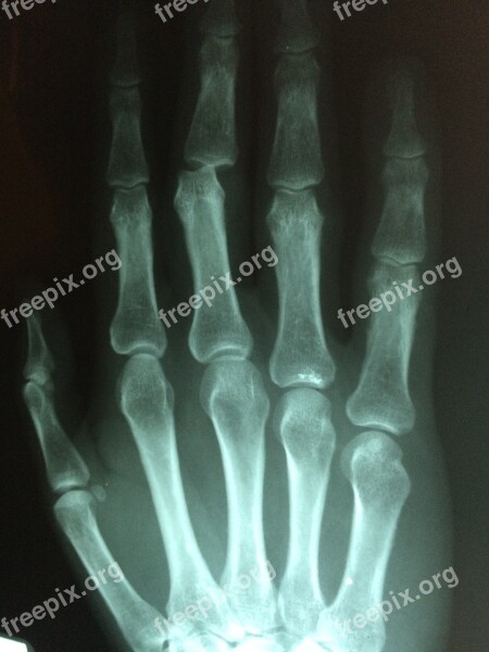 Hand Fracture Broken Injury Pain