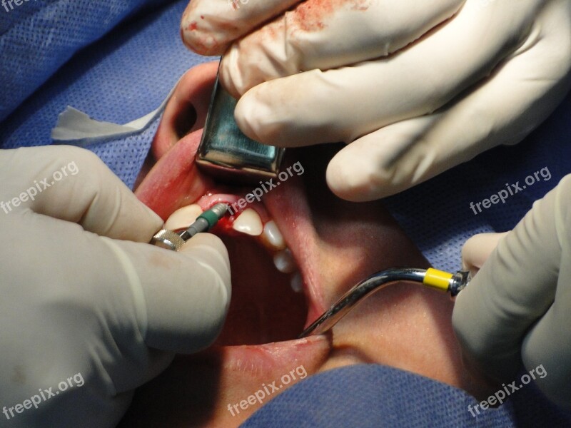 Surgery Teeth Operation Stomatology Implant