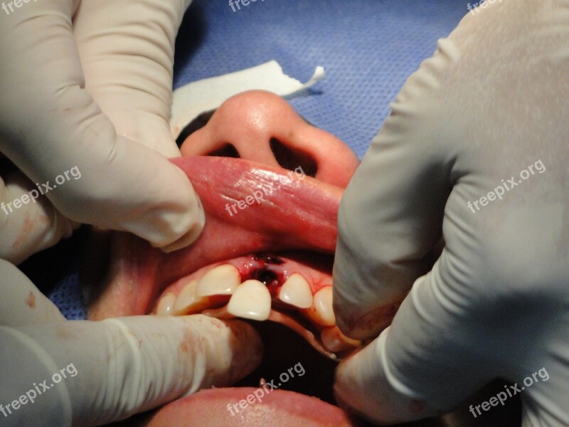 Surgery Teeth Operation Stomatology Implant