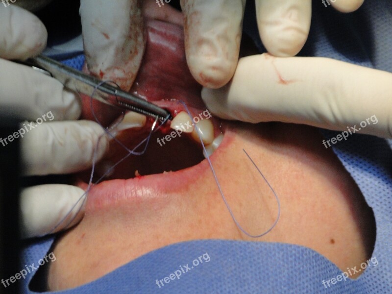 Surgery Teeth Operation Stomatology Implant