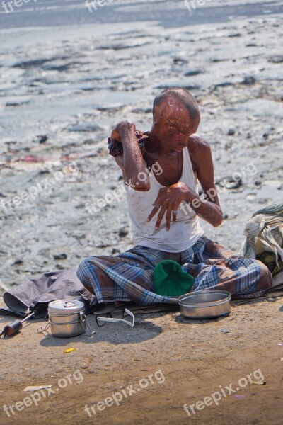 Disabled Burned Skin Poverty Maimed Man