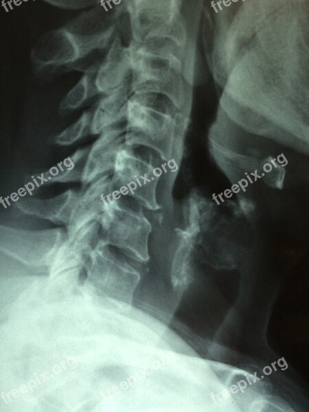 Cancer X-ray Scan Disease Examination