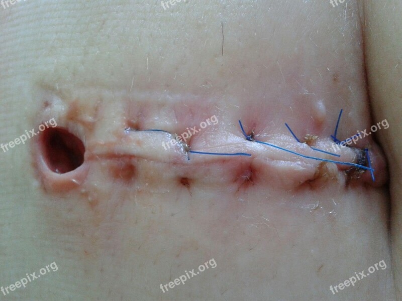 Wound Operation Seam Scar Thread