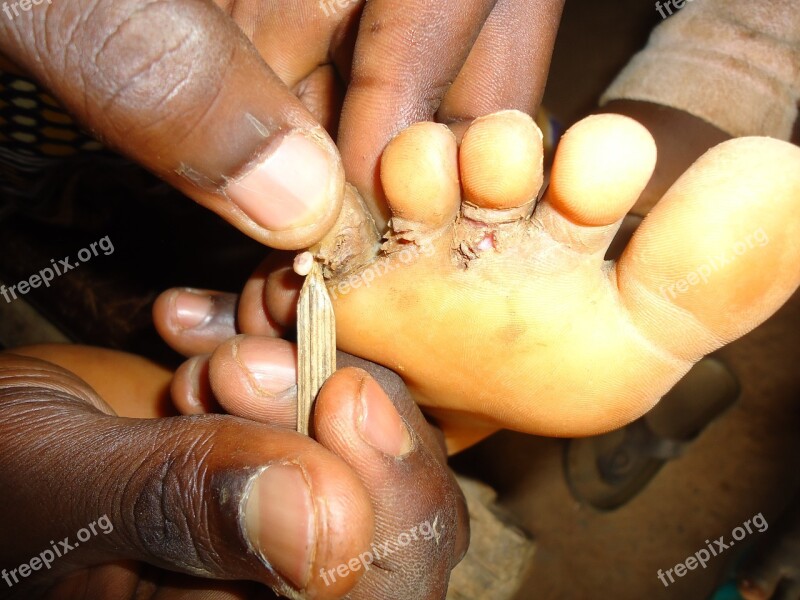 Africa Poverty Disease Foot Pain