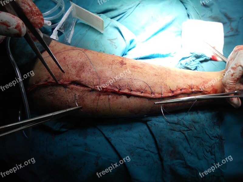 Surgery Orthopedic Arm Hospital Doctor