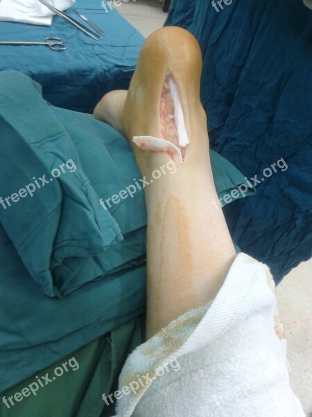 Achilles Tendon Rupture Medicine Anatomy