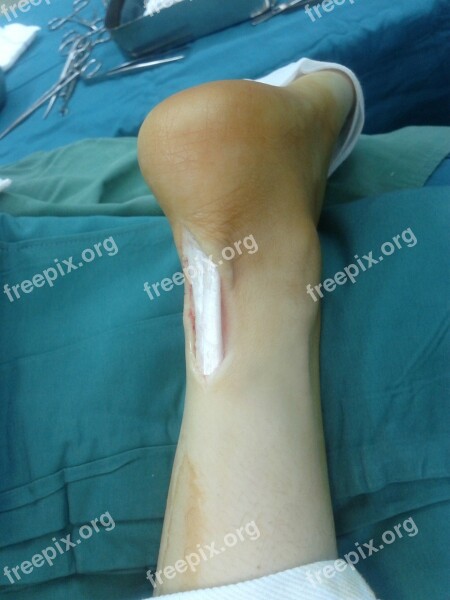 Achilles Tendon Rupture Medicine Anatomy