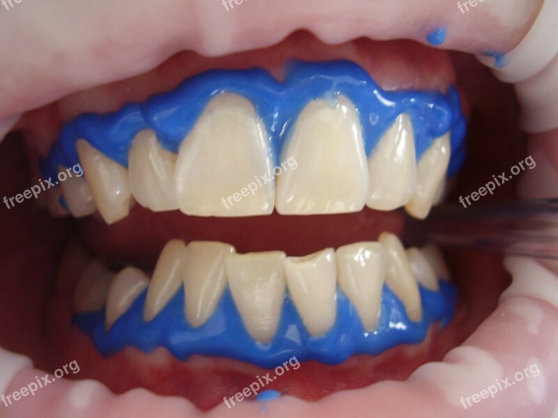 Laser Teeth Whitening Dental Whitening Laser Treatment