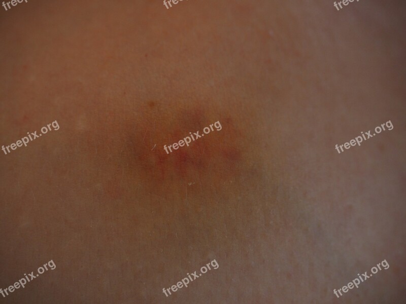 Blue Blot Injury Discoloration Skin Haematoma