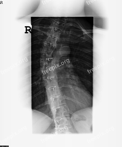 X Ray Image Bone Spine Move Eddy