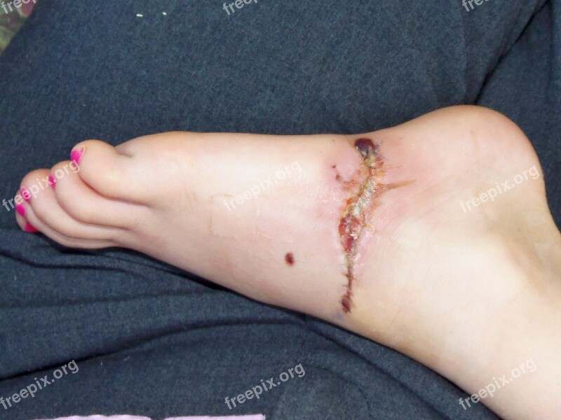 Surgery Recovery Painful Stitches Foot