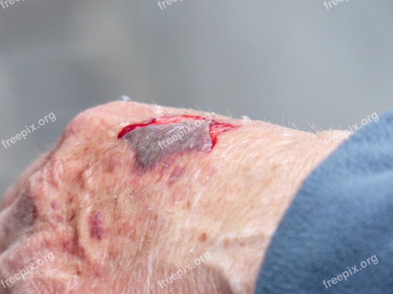 Hand Injury Wound Blood Crack