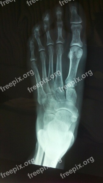 X Ray Foot Bone Free Photos