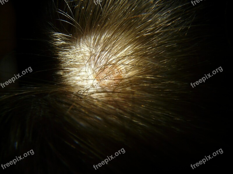 Scalp Mole Head Hair Spot